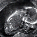 Een bevalling met een grote leegte… DEEL II