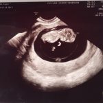 Tijdens de bevalling verdween de hartslag van mijn baby’tje