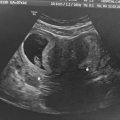 Mijn baby heeft maar een halve baarmoeder om in te groeien, maar dan blijkt er nog iets afwijkend te zijn