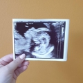 Tijdens onze tweede ICSI poging blijk ik spontaan zwanger