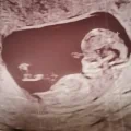 Efka hoopt via eiceldonatie zwanger te worden: de terugplaatsing van ons laatste embryo, onze laatste hoop