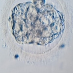 Kelly: “Na de IVF punctie kreeg ik ondraaglijke pijn, niet opereren was geen optie: “Dan haalt u morgen niet mevrouw”
