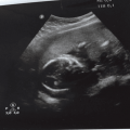 We kregen de schrik van ons leven: met 18 weken zwangerschap begon ik te bloeden